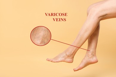Woman suffering from varicose veins on pastel gold background, closeup. Magnified skin surface showing affected area