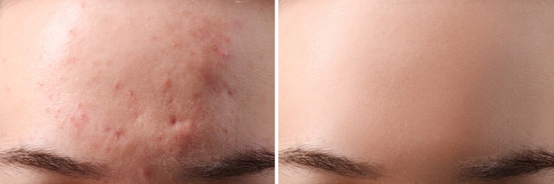 Image of Collage with photos of woman with acne problem before and after treatment, closeup. Banner design