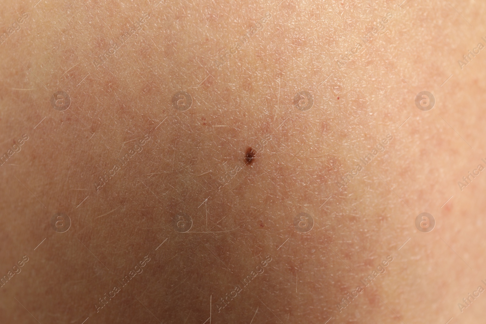Photo of Closeup view of woman's body with birthmark