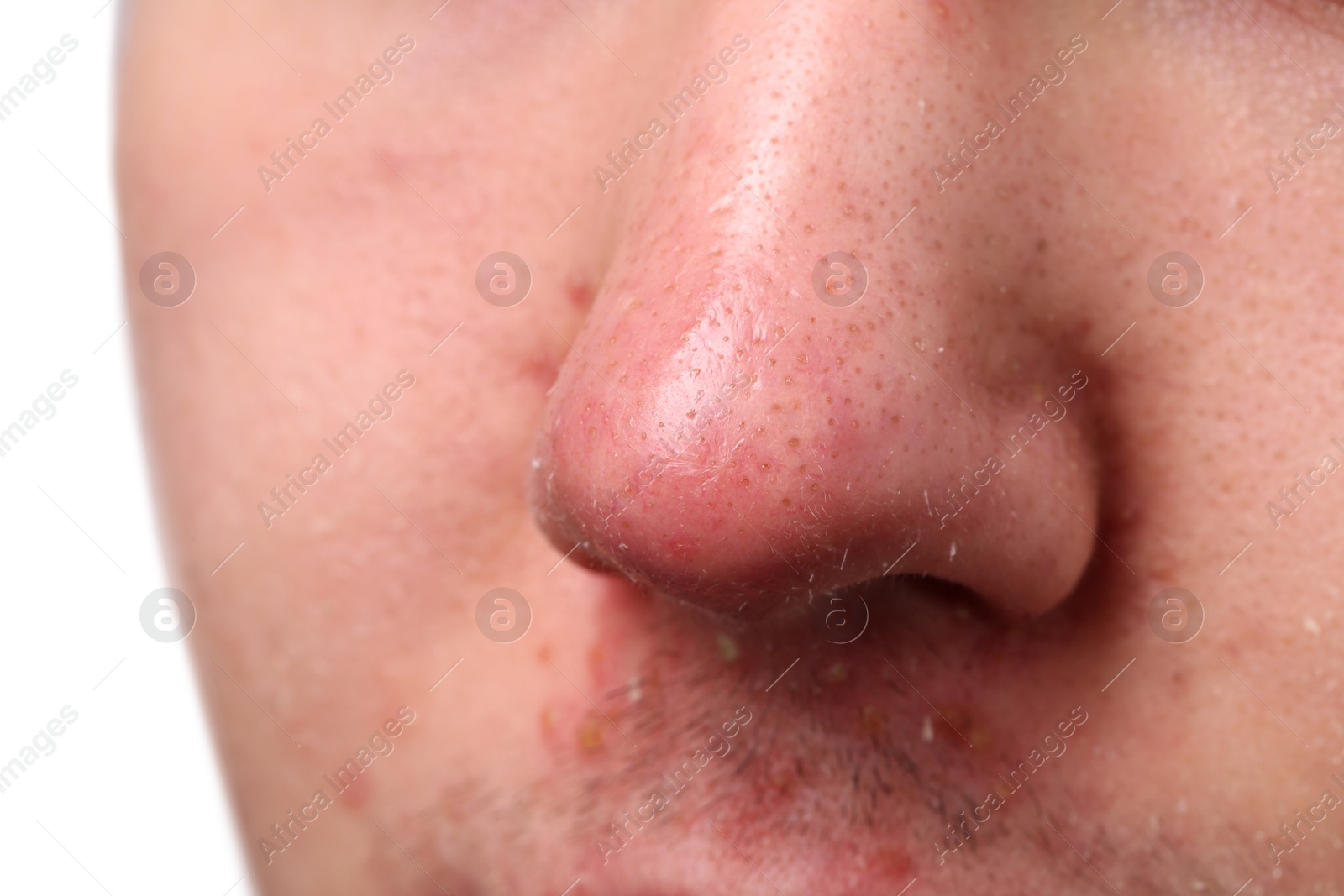 Photo of Young man with acne problem, closeup view of nose