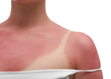 Photo of Woman with sunburned skin on white background, closeup