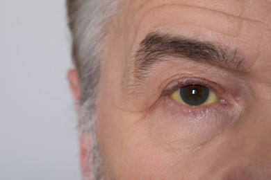 Senior man with yellow eyes on light background, closeup. Symptom of hepatitis