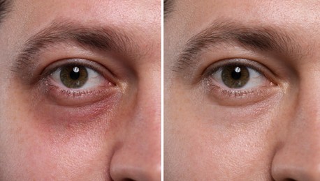 Image of Collage with photos of man with dark circle under eye before and after treatment, closeup