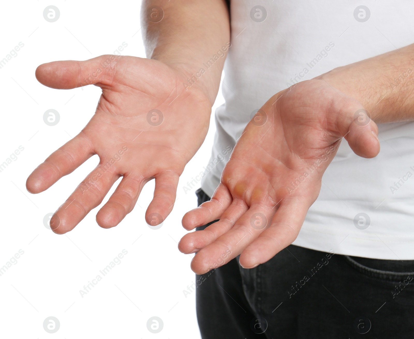 Image of Man showing hands without and with calluses on white background., closeup