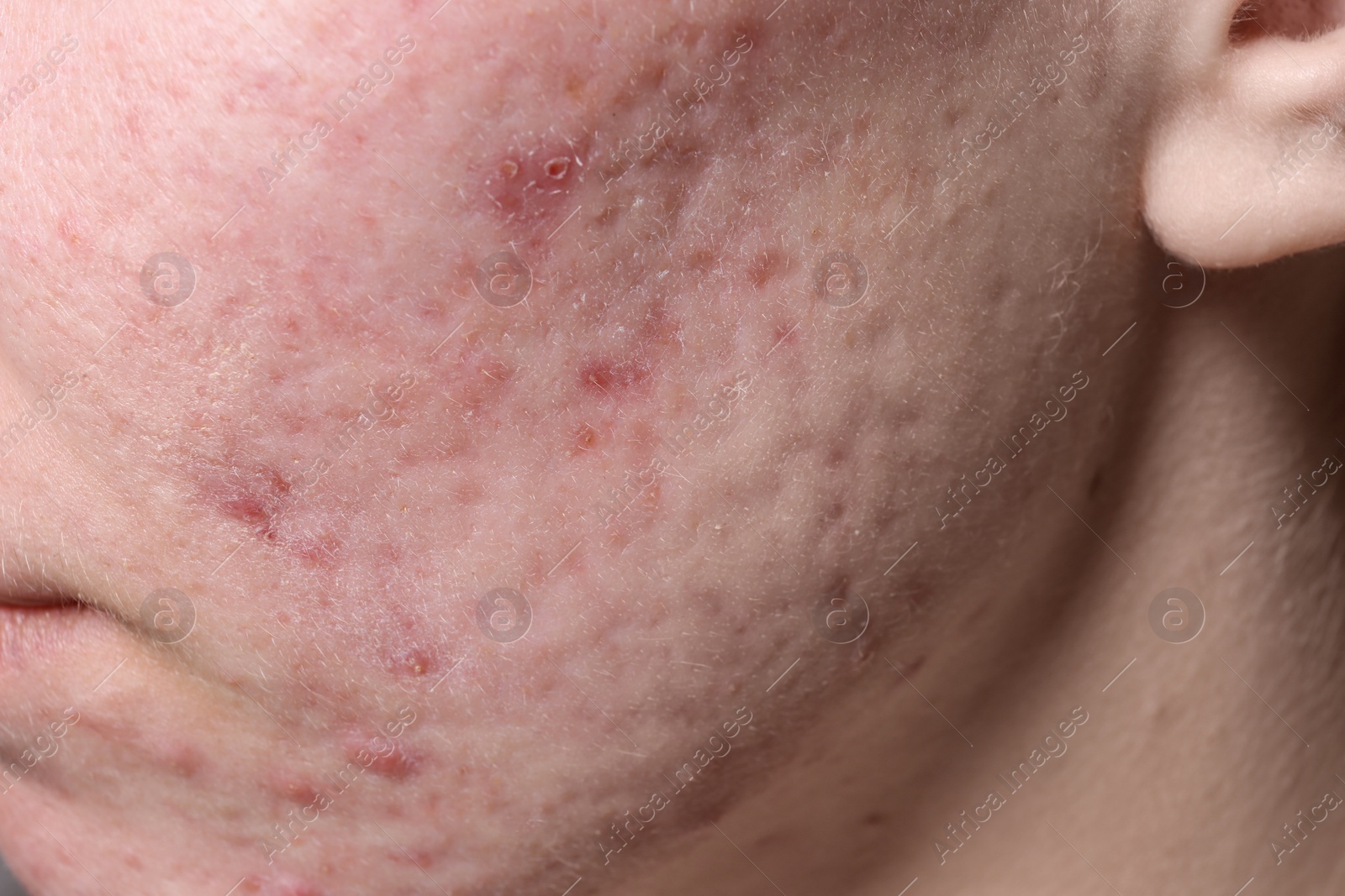 Photo of Young woman with acne on her face, closeup