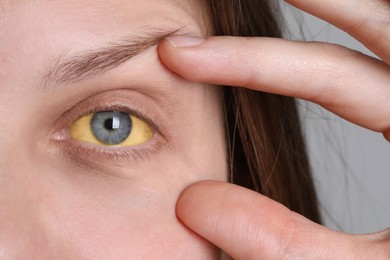 Woman with yellow eyes on light background, closeup. Symptom of hepatitis