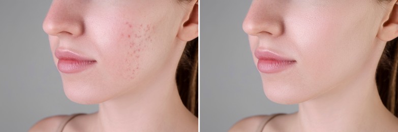 Image of Acne problem. Young woman before and after treatment on grey background, closeup. Collage of photos