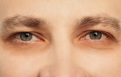 Image of Tired man with dark circles under eyes, closeup