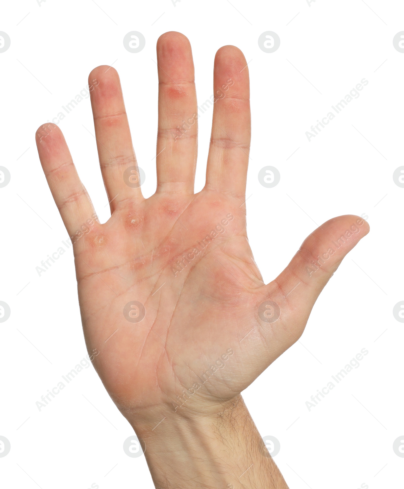Photo of Man suffering from calluses on hand against white background, closeup