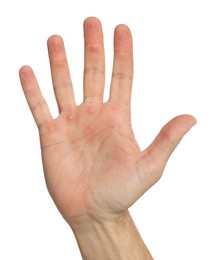 Man suffering from calluses on hand against white background, closeup