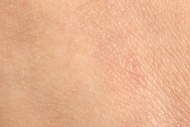 Photo of Texture of healthy skin as background, macro view