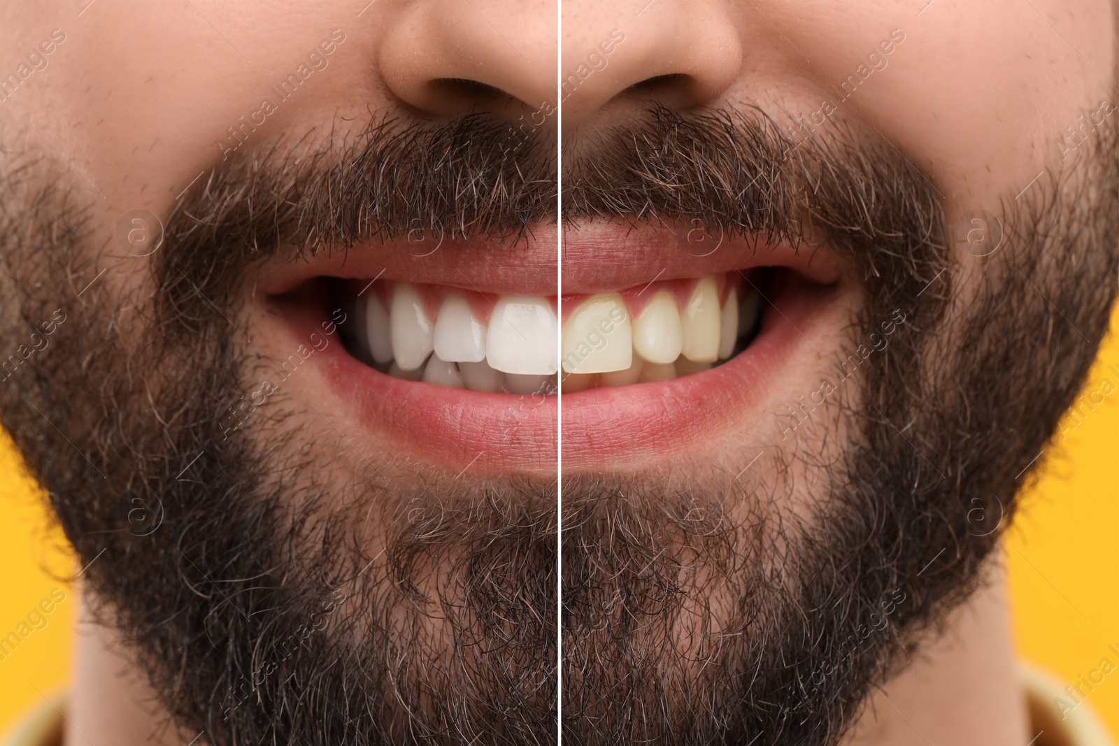 Image of Man showing teeth before and after whitening on orange background, collage