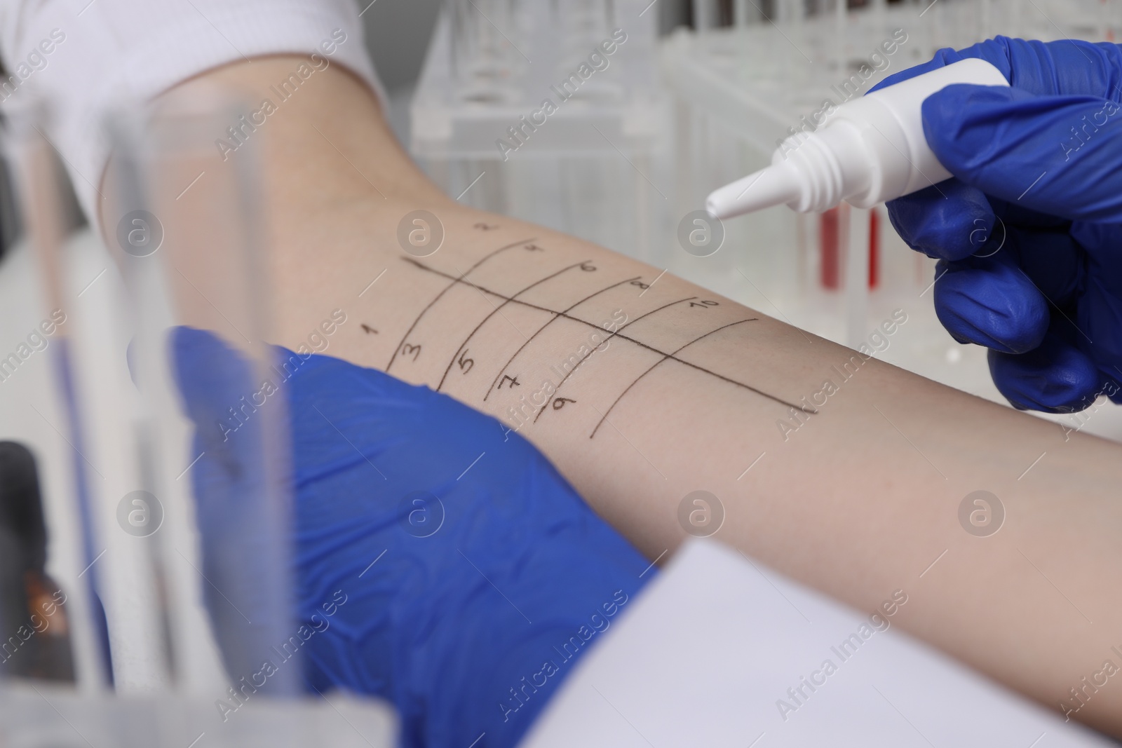 Photo of Doctor doing skin allergy test at light table, closeup