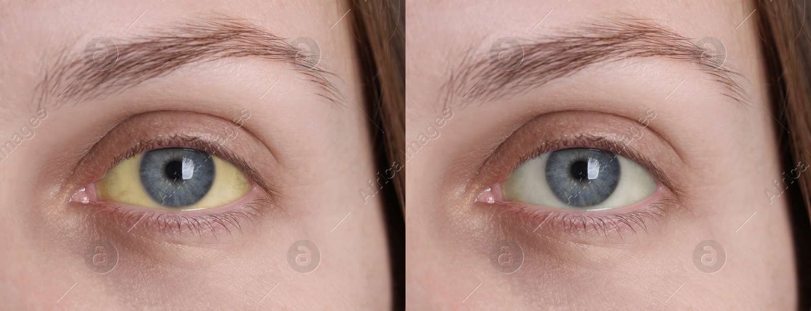 Image of Collage with photos of woman before and after hepatitis treatment, focus on eyes. Banner design
