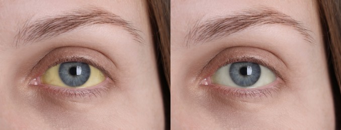 Image of Collage with photos of woman before and after hepatitis treatment, focus on eyes. Banner design