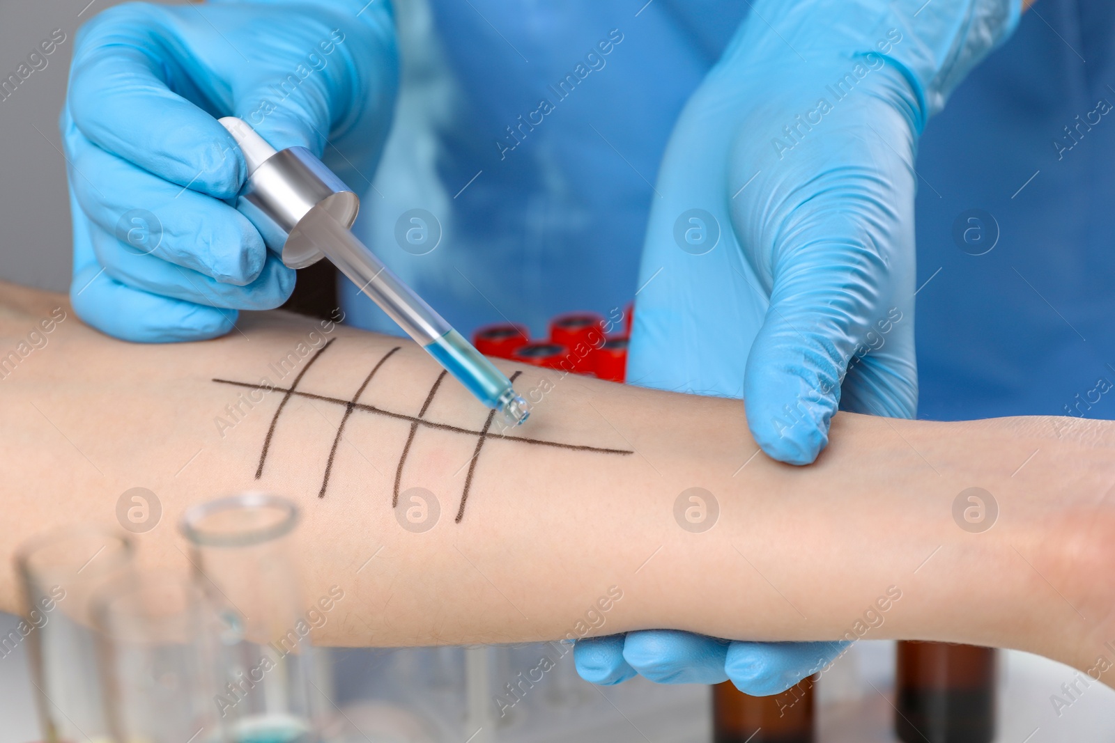 Photo of Doctor doing skin allergy test in clinic, closeup