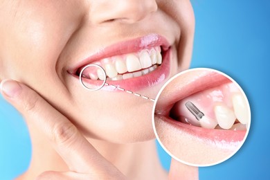 Image of Woman with beautiful smile after dental implant installation procedure on blue background, closeup
