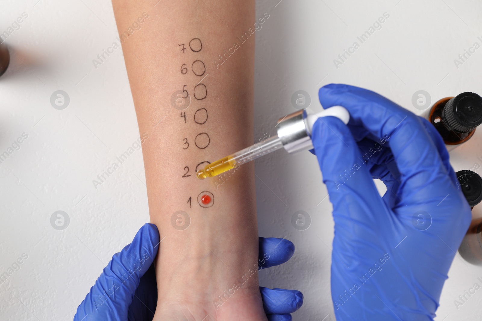 Photo of Doctor doing skin allergy test at light table, top view