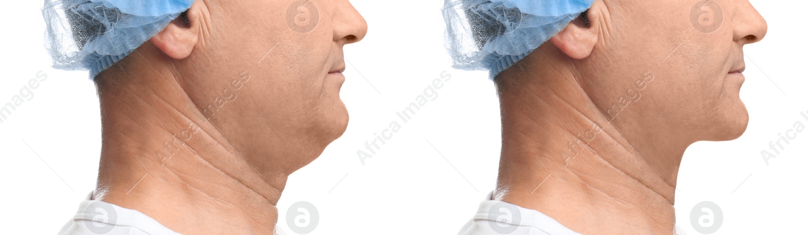 Image of Mature man before and after plastic surgery operation on white background, closeup. Double chin problem