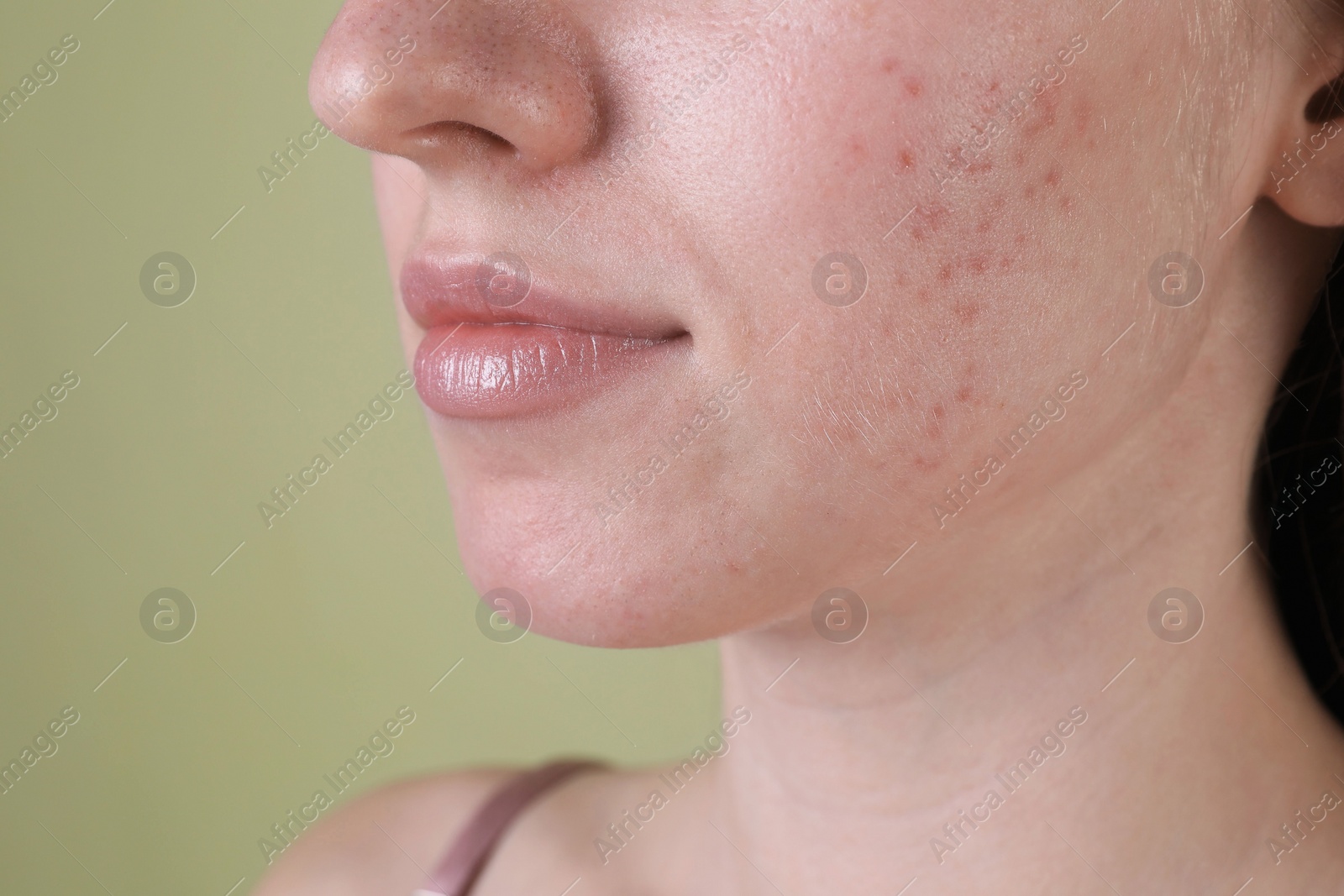 Photo of Young woman with acne problem on olive background, closeup