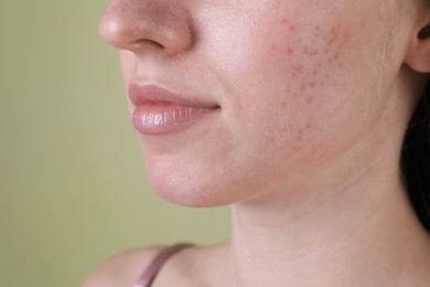 Young woman with acne problem on olive background, closeup