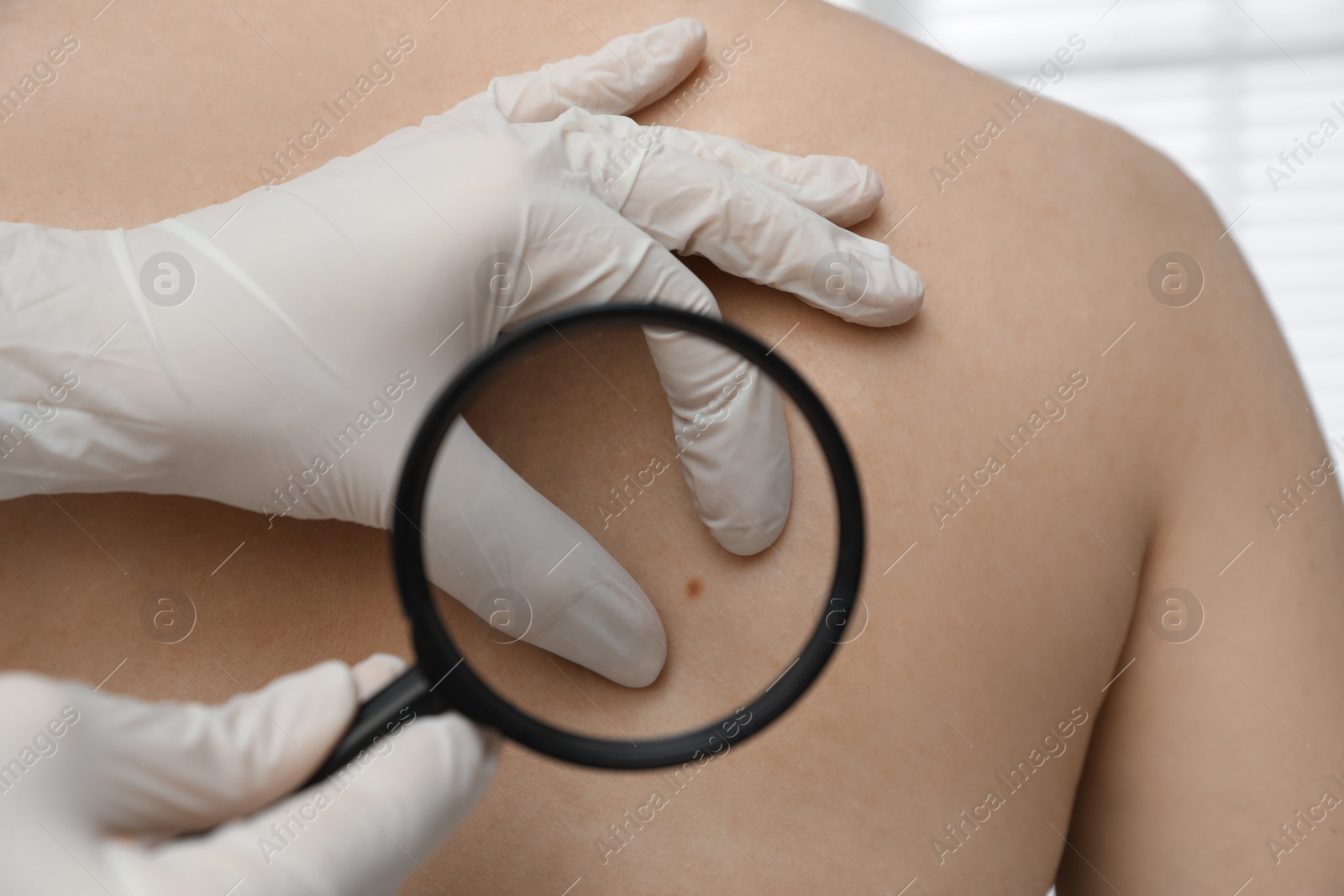 Photo of Dermatologist examining patient's birthmark with magnifying glass in clinic, closeup view