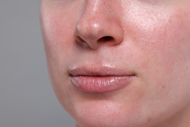 Photo of Closeup view of woman with reddened skin on grey background