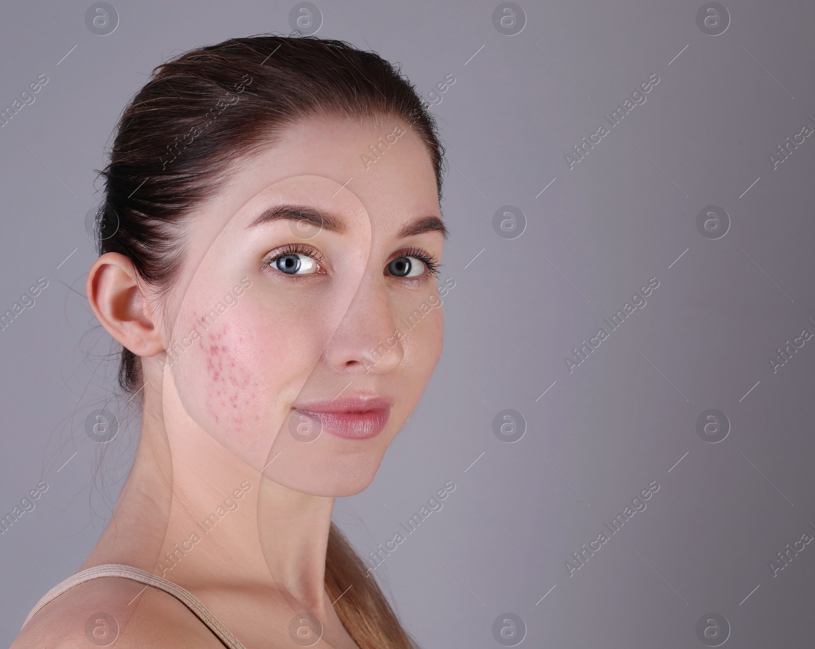Image of Acne problem, collage. Woman before and after treatment on grey background, space for text