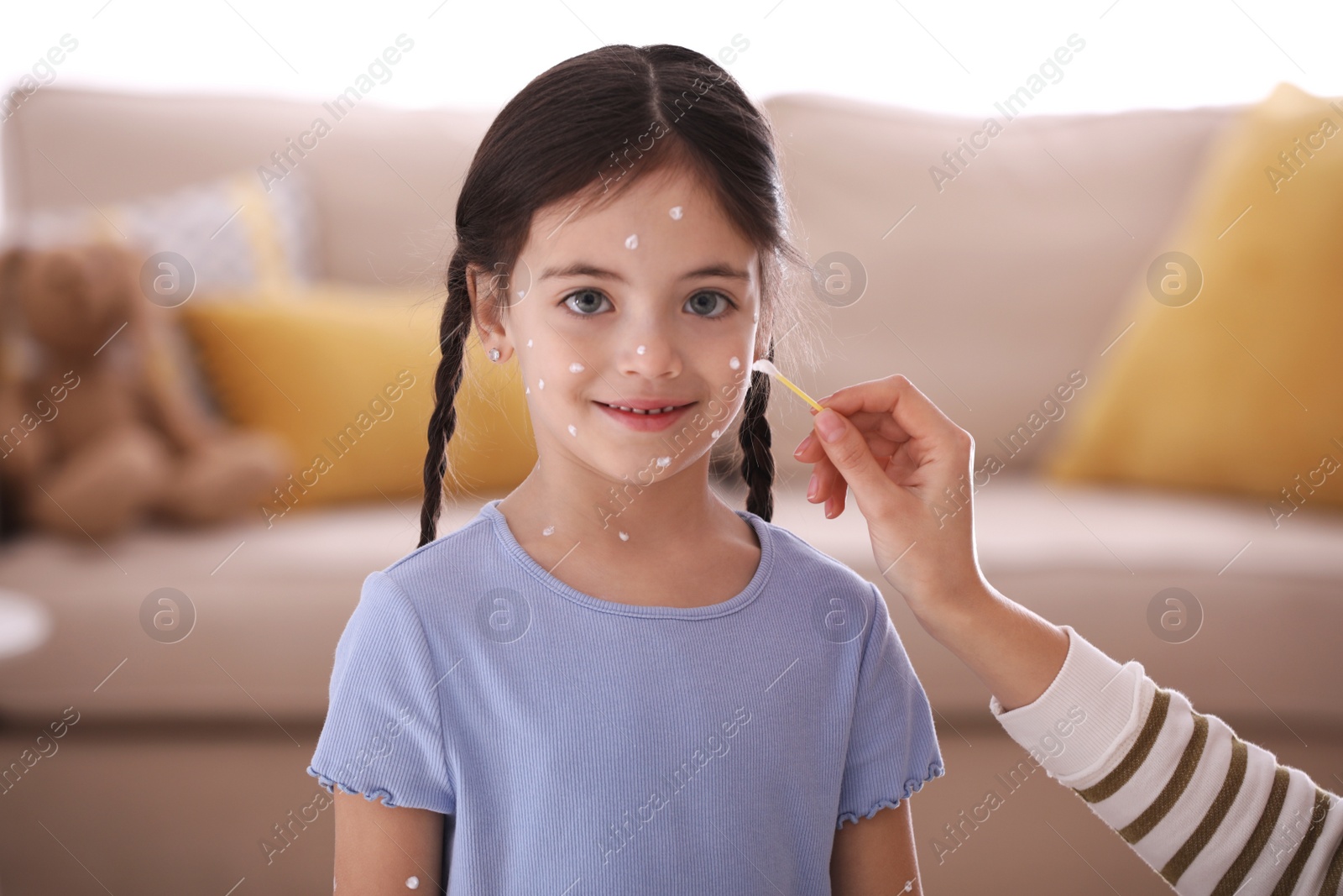 Photo of Mother applying cream onto skin of her daughter with chickenpox at home