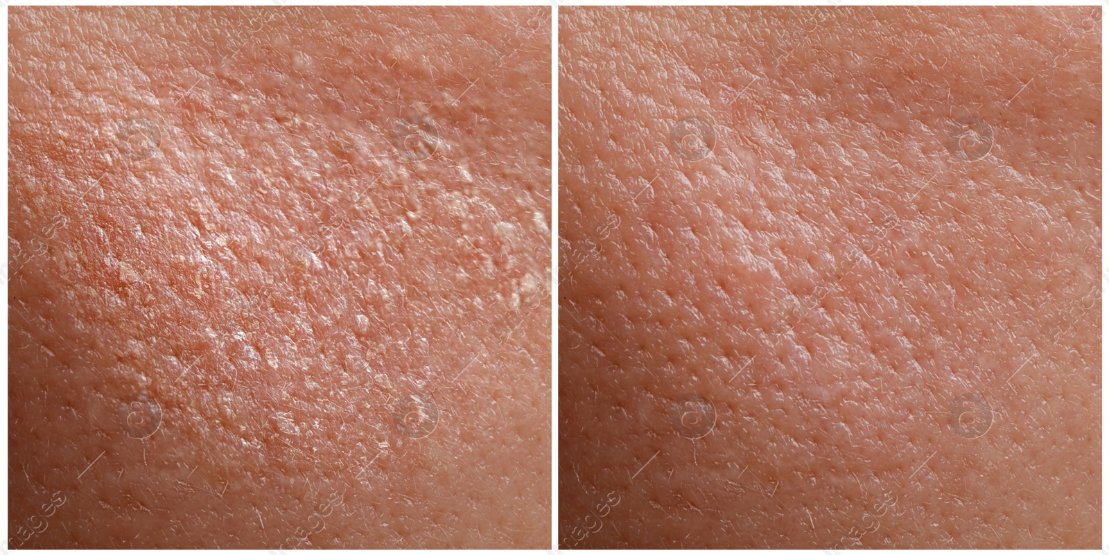 Image of Collage demonstrating comparison of dry and moisturized human skin, closeup. Banner design