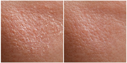 Image of Collage demonstrating comparison of dry and moisturized human skin, closeup. Banner design