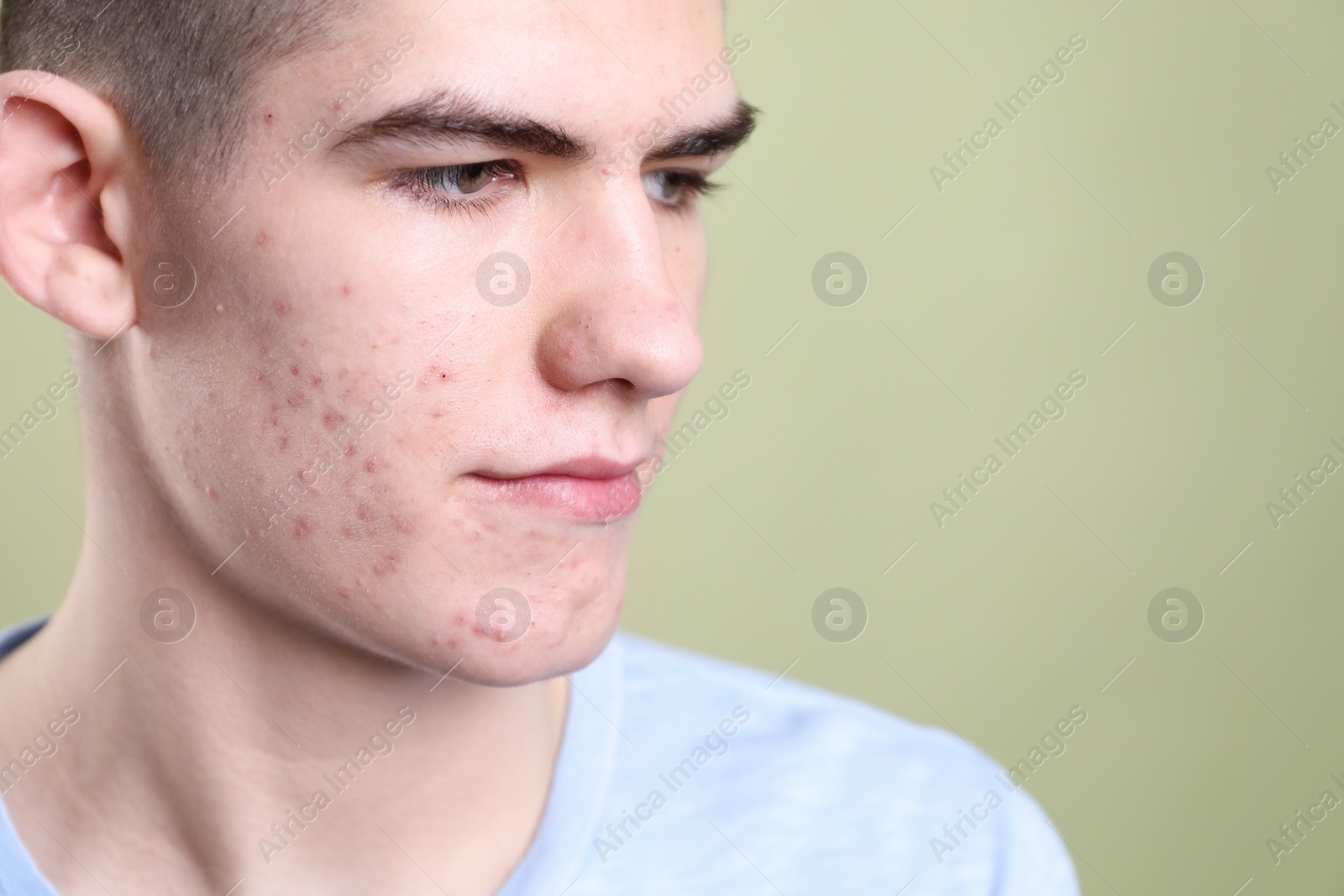 Photo of Young man with acne problem on olive background, closeup