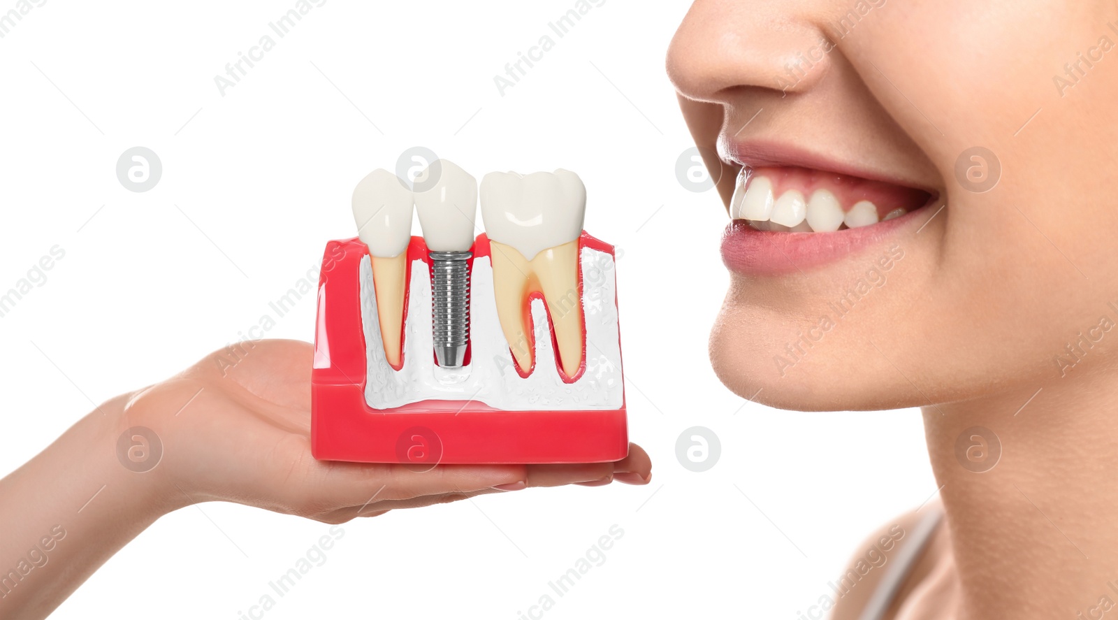 Image of Young woman with beautiful smile and dentist holding educational model of dental implant on white background, closeup