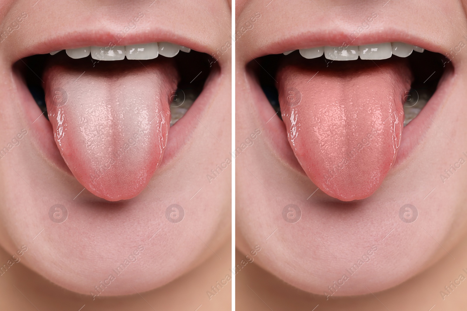 Image of Woman showing her tongue before and after cleaning procedure, closeup. Tongue coated with plaque on one side and healthy on other, collage