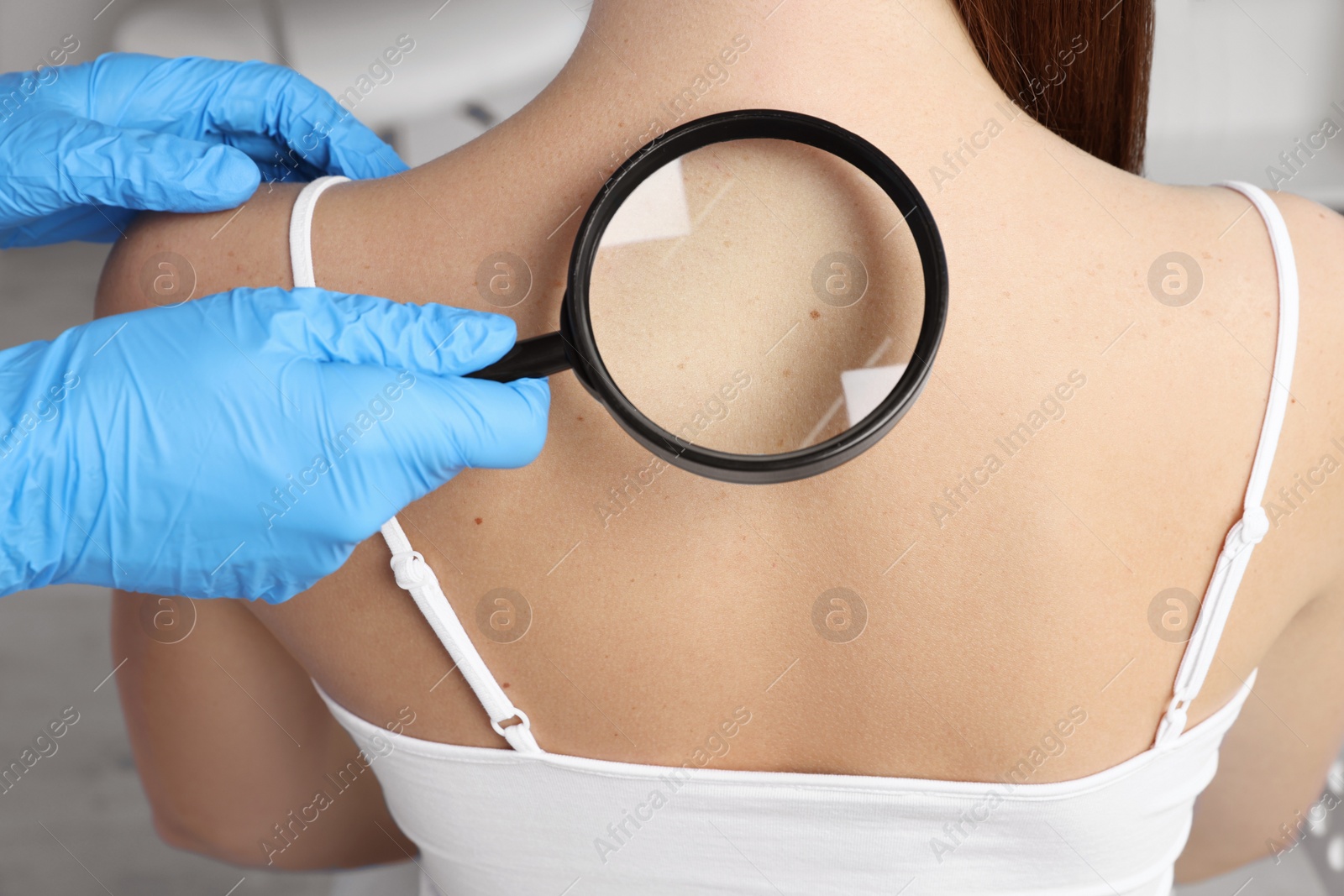 Photo of Dermatologist examining patient's birthmark with magnifying glass in clinic, closeup