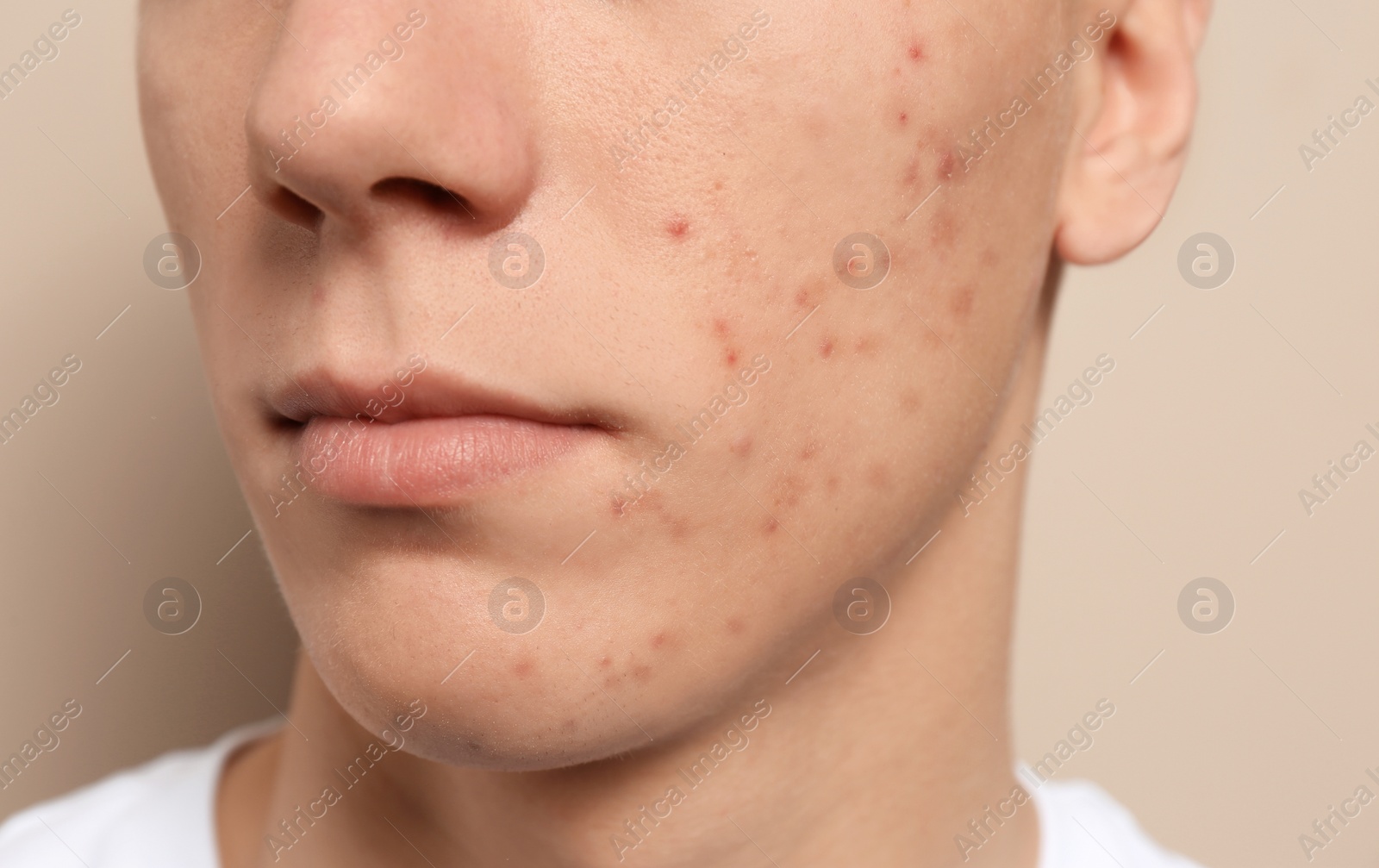 Photo of Teen guy with acne problem on beige background, closeup