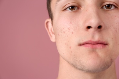 Photo of Young man with acne problem on color background