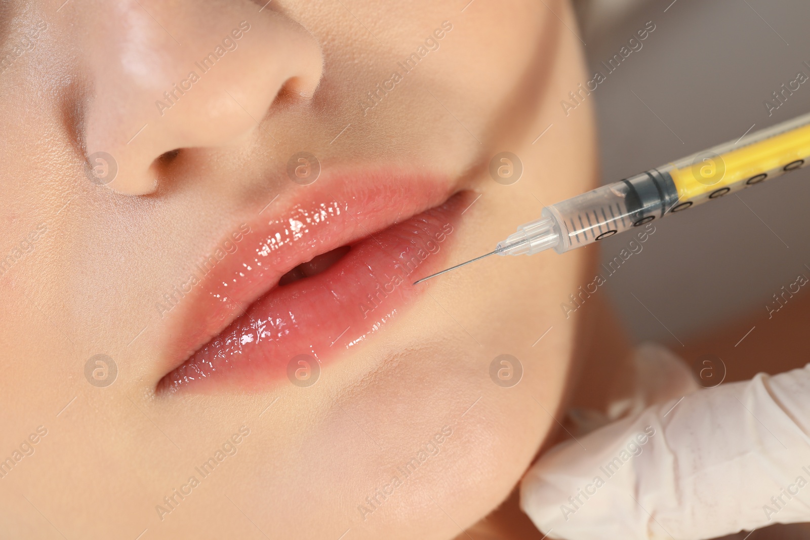 Photo of Young woman getting lips injection, closeup. Cosmetic surgery