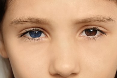 Image of Little girl with different colors of eyes, closeup. Heterochromia iridis
