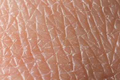 Photo of Texture of dry skin as background, macro view