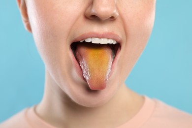 Photo of Gastrointestinal diseases. Woman showing her yellow tongue on light blue background, closeup