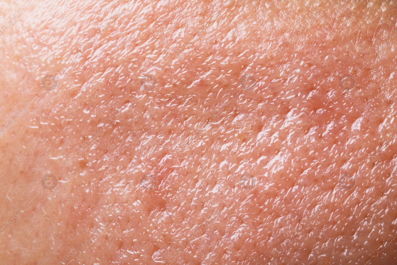 Photo of Closeup view of human oily skin as background