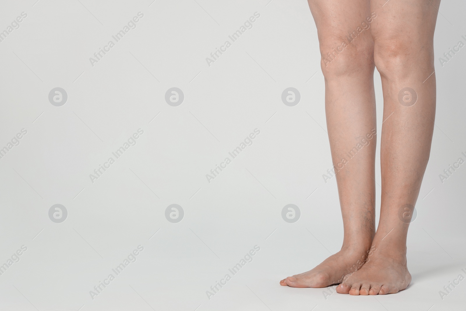 Photo of Closeup view of woman with varicose veins on light background. Space for text