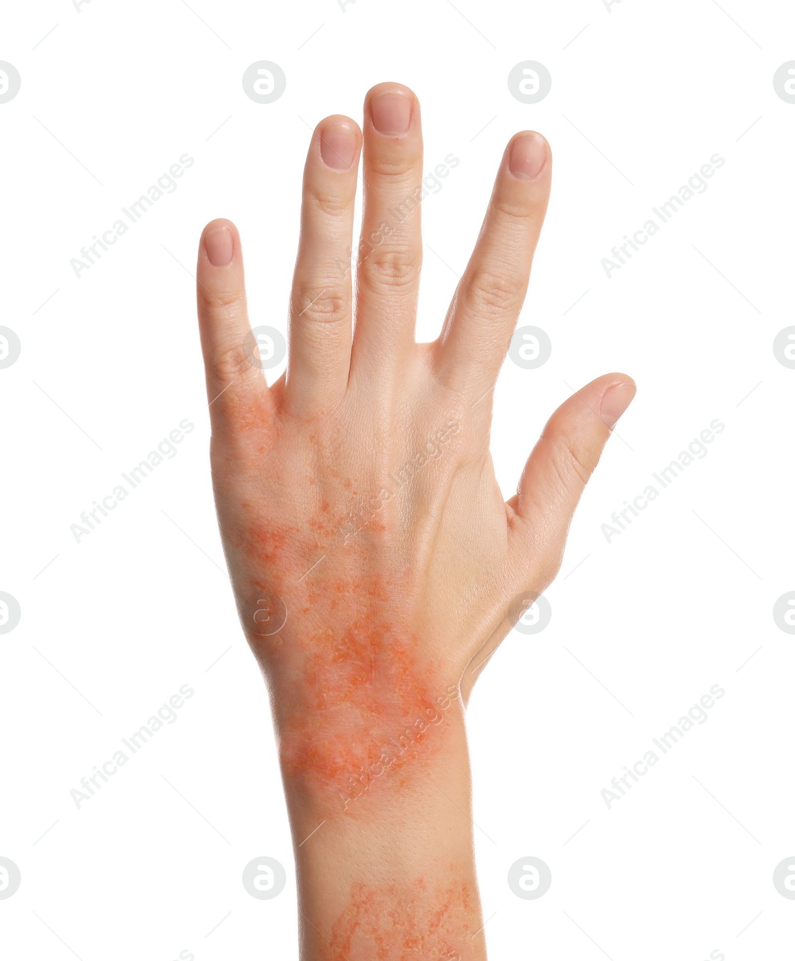 Image of Woman showing hand with dry skin on white background, closeup