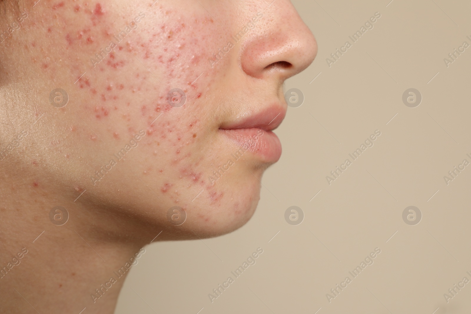 Photo of Teenage girl with acne problem on beige background, closeup