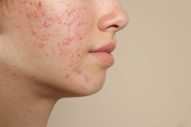 Teenage girl with acne problem on beige background, closeup