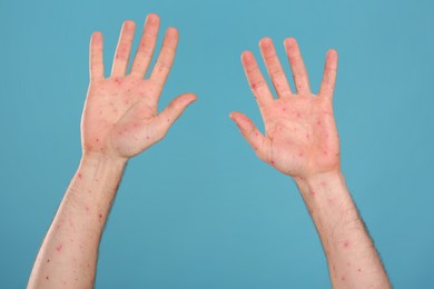 Photo of Man with rash suffering from monkeypox virus on light blue background, closeup