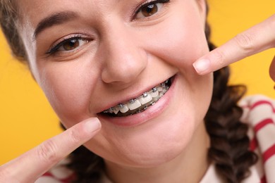 Happy woman pointing at braces on her teeth against orange background, closeup