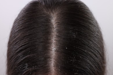 Closeup view of woman`s dark hair with dandruff on white background