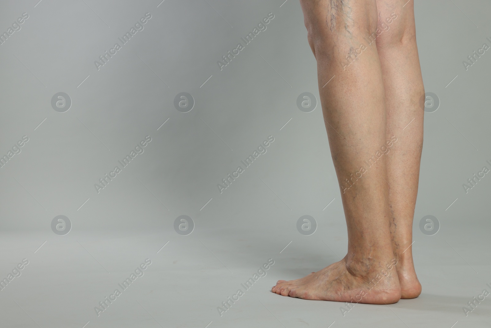 Photo of Closeup view of woman with varicose veins on light grey background. Space for text